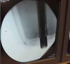 A screw anchored intramedullary hip stem